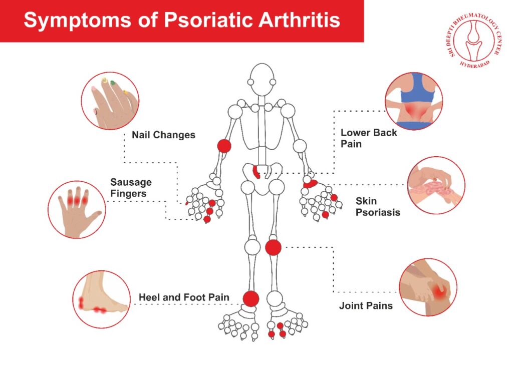 Psoriatic Arthritis – Dr URK Rao