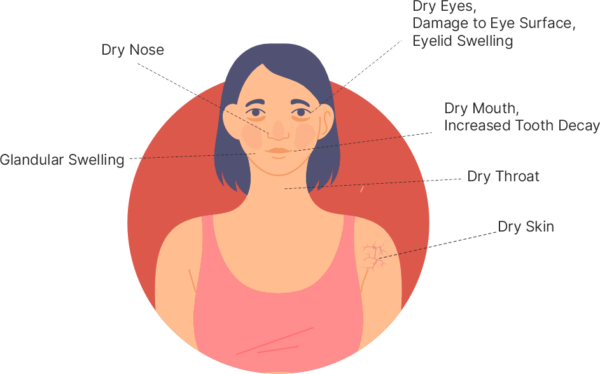 Sjogren’s syndrome - Dr URK Rao